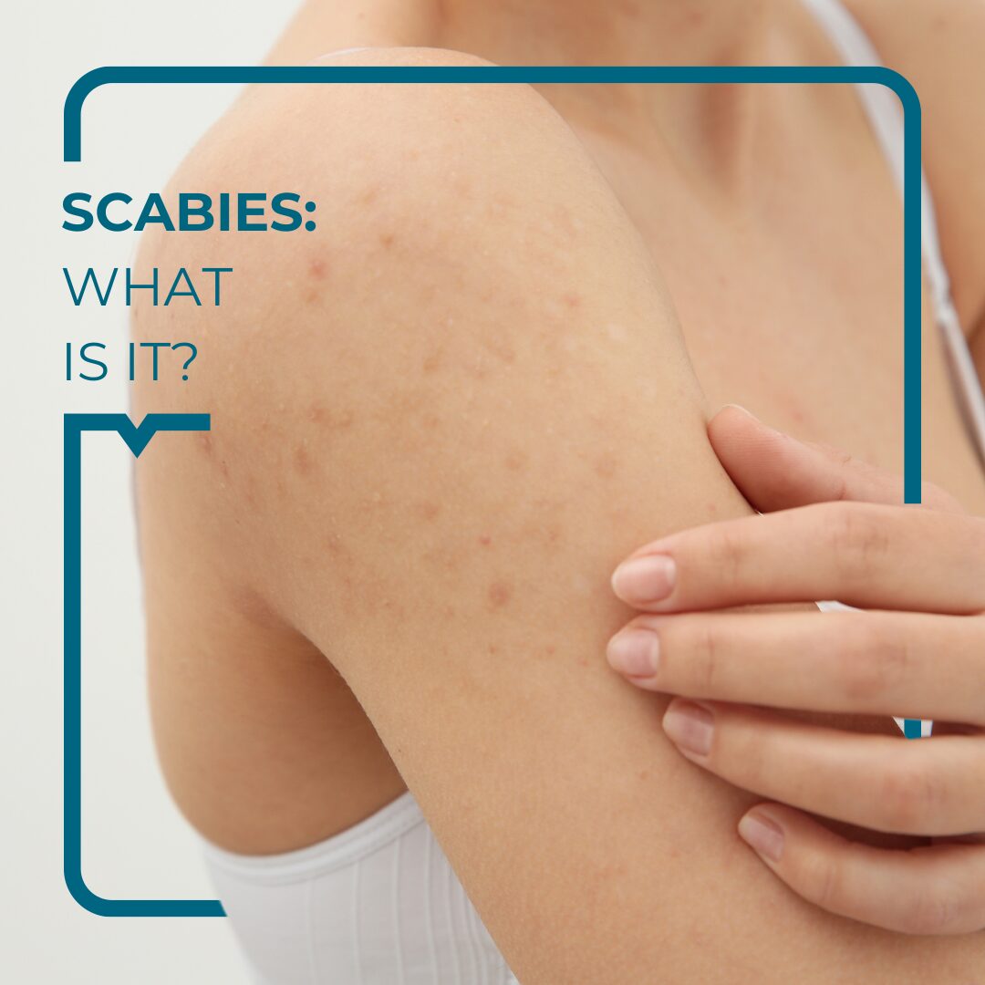 Beginning Stages Of Scabies Scabies Symptoms And Treatment